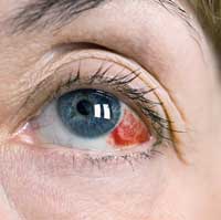 Глазные кровоизлияния
